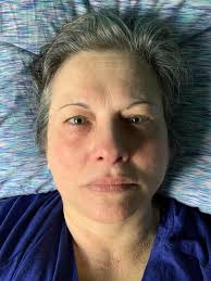 Currently dealing with a flare-up, haven't had one in awhile.