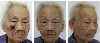 Reconstruction of skin defects in the medial cheek using lateral cheek  rotation flap combined with Z-plasties.