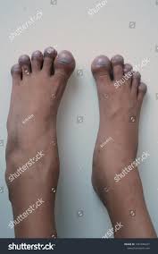 Image result for Clubbing nails feet