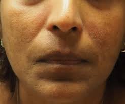 Diagnosis and Management of Cutaneous Manifestations of Autoimmune  Connective Tissue Diseases