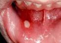 Pilzinfektion der Mundschleimhaut - DocCheck Flexikon