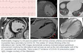 Patients have an abnormal diffusion capacity of the. Which Modality And When New Guidance For Cardiac Imaging In Covid 19 Tctmd Com