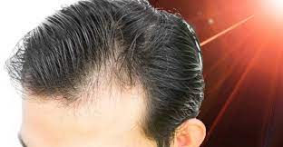 Laser hair growth is one of the latest haircare trends to hit the market today. Does Laser Hair Growth Work Here Are Your Options For Lllt Hair For Keeps