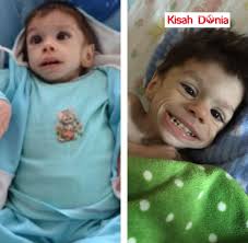 Kanak-kanak Ini Tinggal Rangka dan Doktor Menjangkakan Dia Akan Mati,Tapi  Lihatlah Keadaan Dia Selepas Diambil Keluarga Angkat