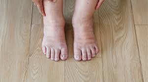 Image result for diabetic toes