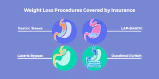Number one, you do have to meet a certain weight requirement, so your bmi. Weight Loss Surgery Insurance Secrets Revised List