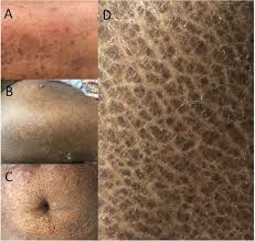 Image result for Ichthyosis