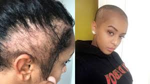 You can experience hair loss when you're going through a situation that increases your stress levels. What Causes Hair Loss In Teenagers Hair Loss Clinic In Toronto And The Greater Toronto Area
