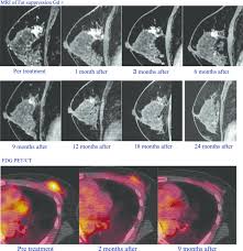 Yet most research around treatment, including clinical trials, focuses on women much. A Clinical Study Of Curative Partial Breast Irradiation For Stage I Breast Cancer Using Carbon Ion Radiotherapy Springerlink