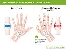 Sie können aber auch innere organe wie die lunge oder den kehlkopf befallen. Rheuma Ursachen Symptome Diagnose Behandlung