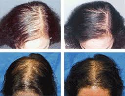 Who gets and causes. avram, m. Laser Hair Therapy Nassau Suffolk County Ny Hair Solutions Of Long Island