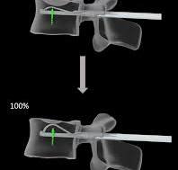 Efficiency of a novel vertebral body augmentation system ...