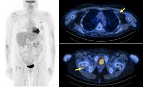 Pet scans aid in the diagnosis and location of tumors. Vereos Digital Pet Ct Philips