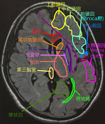 左 半 側 空間 無視 病巣
