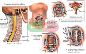 Now I Understand Why People Cringe When I Explain It To Them Cervical Spinal Stenosis Spinal Fusion Surgery Spine Surgery