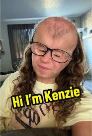 Mackenzie Bald Head with Disease