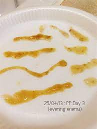Mucus Stringy Stool Images Nomor Siapa