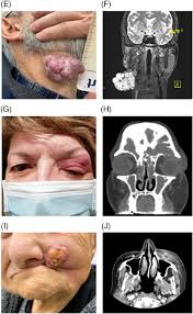 Case 3: E, right paramandibular, stony‐hard, irregular‐shaped, 8 × 6 cm... 