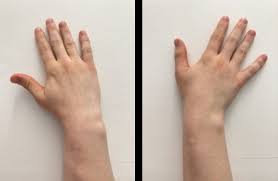 Image result for Scaphoid Fracture Signs