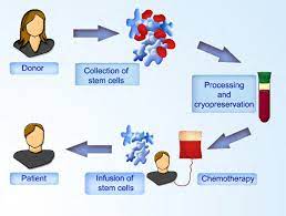 Learn what makes memorial sloan kettering one of the best places to have a stem cell transplant. Allogeneic Stem Cell Transplantation Hematopoietic Stem Cells Are Download Scientific Diagram
