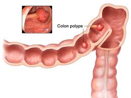 Furthermore, wbcs and crp levels tend to be chronically elevated in smokers. Tests To Detect Colorectal Cancer And Polyps National Cancer Institute