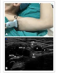 Image result for Axillary Nerve Block