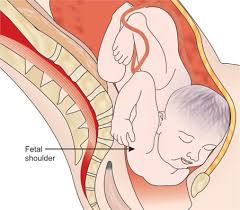 Image result for Shoulder Presentation