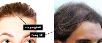 How do you know if you're going bald? Am I Going Bald How To Tell And What To Do Nicehair Org