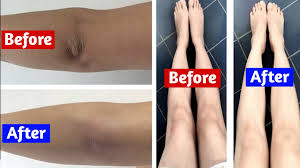 Why are my knees so dark? Search Youtube Channels Noxinfluencer