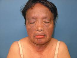 Image result for Photodermatitis