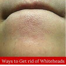 When it comes to whiteheads, clogged pores are the main culprit. How To Get Rid Of Whiteheads Beauty Remedies How To Get Rid Of Whiteheads Health And Beauty Tips