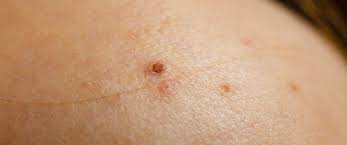 التهاب الشامة دليلك الشامل ويب طب