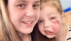 Young girl receives lifetime scar after dog attack amid call for breed ban