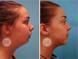 It is commonly a jaw related problem, but minor cases can be corrected with traditional dentistry. Dr Guy Watts Plastic Surgeon Perth Jaw Surgery Orthognathic