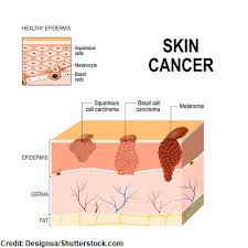 The symptoms of skin cancer vary depending on the cancer, but in general, the best thing you can do to catch skin cancer early is to keep an eye on any strange lumps or bumps on your dog's body,. Skin Cancer Nursing Nclex Review