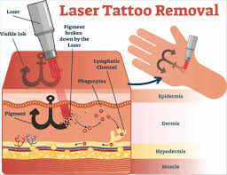 Considering tattoo removal in singapore? Laser Tattoo Removal Singapore Review Stop Wasting Money On Bad Treatments 2019