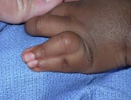 Image result for Syndactyly