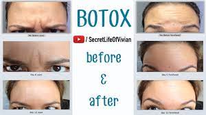 Botox pictures day by day. Botox Before After Youtube
