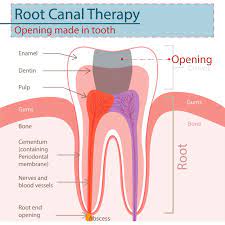 Can I Still Have Pain After A Root Canal Creekside Endodontics