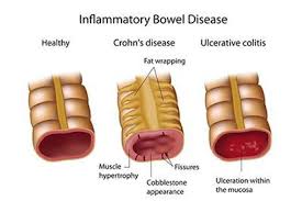 Image result for Ulcerative Colitis