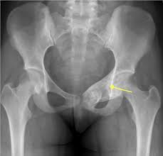 Persistent or unusual pain or swelling in or near a bone can be caused by cancer or by other conditions. Cureus Pelvic Aneurysmal Bone Cyst In An Adolescent A Case Report And Literature Review