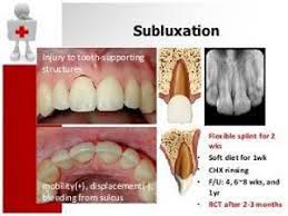 Image result for Tooth Luxation