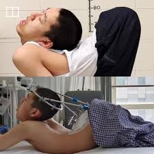 Man with 180-degree spinal bend walks upright