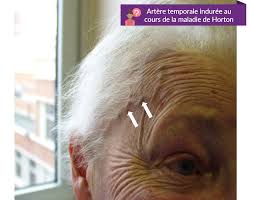 Une présentation aiguë peut devenir mortelle en quelques heures, par contre, si notre chat souffre d'une insuffisance rénale chronique, elle peut être maintenue avec une. Maladie De Horton Les Reponses A Vos Questions