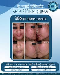 Aradhya ayurvedic hospital & panchkarma research center. Say Bye Bye To Pimples Scar Book Delphi Skin Care Hospital Facebook