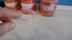 How to clean your retainer with a uv sanitiser Swords Orthodontics Blog A Dozen Dos And Don Ts 12 Tips For Successful Orthodontic Retainer Wear