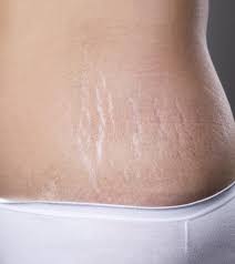 Check spelling or type a new query. How To Remove Stretch Marks After Pregnancy 16 Home Remedies