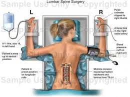 There S A Picture Of Me Like This That Exists In Real Life And I M Really Glad I Ve Never Seen It Spine Surgery Scoliosis Surgery Spinal Fusion Surgery