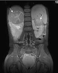 Image result for Nephroblastoma