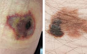Image result for Spider Bite